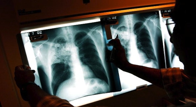 Онколог: 4250 годишно се разболяват от рак на белия дроб в България