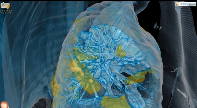 Учени показаха чрез виртуална реалност как коронавирусът обхваща белите дробове