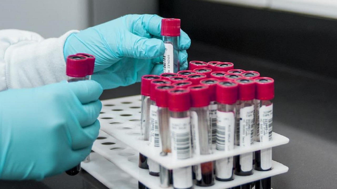 Експерт: 100% нямаме потвърдена проба на хепатит