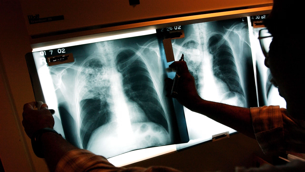 За тревожна тенденция в ръста на скритата заболеваемост от туберкулоза сигнализират