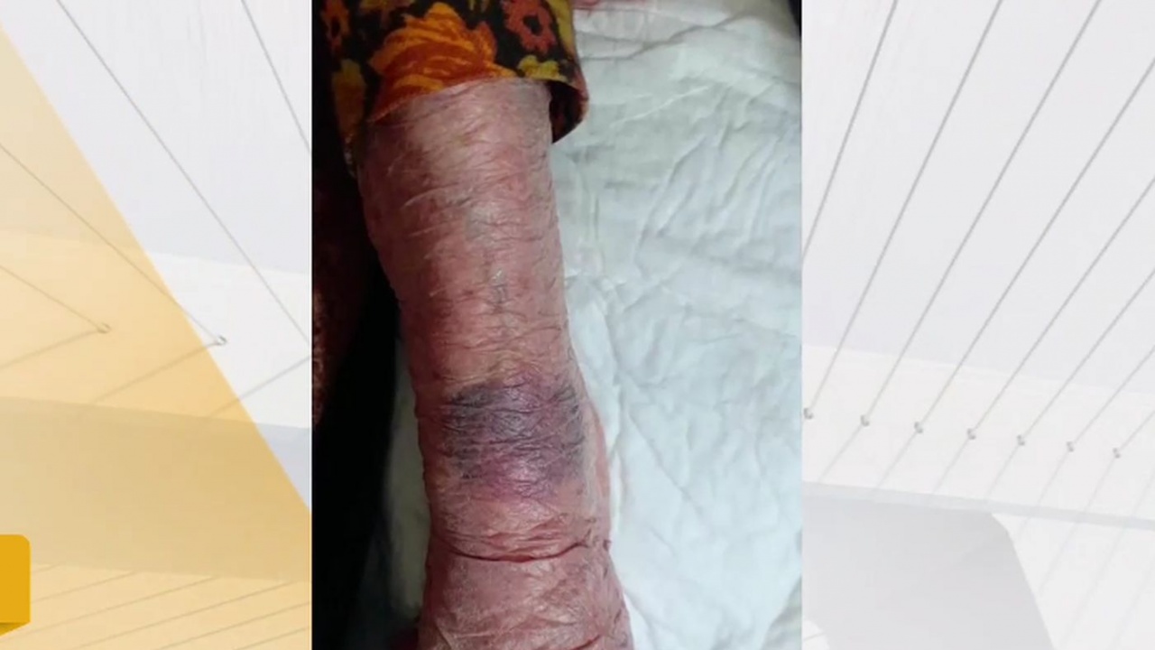 Гладна, жадна и вързана: Проявено ли е насилие над 104-годишна пациентка в болницата във Видин