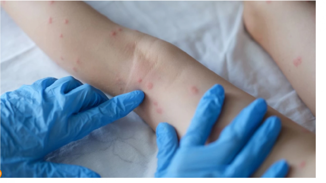 Ръст на случаите на варицела отчитат в Девин